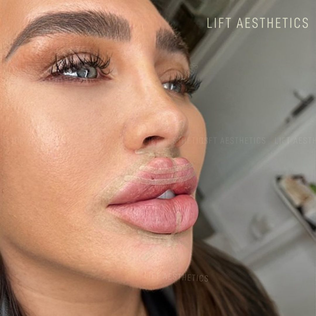 lift aesthetics show lauryn goodger with butterfly lips